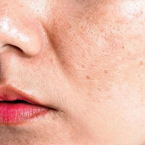 Acne and Scar Treatment